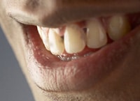 Ursachen für Mundgeruch Halitosis