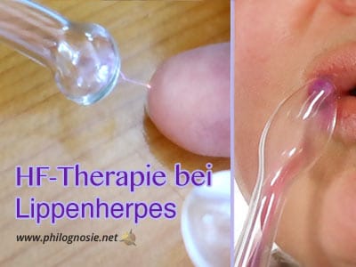 Hochfrequenz: Lippenherpes mit dem HF-Stab behandeln