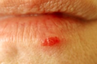 Lippenherpes Bläschen an der Lippe Hausmittel