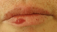 Lippenherpes blase an der Lippe
