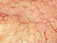 rote Äderchen teleangiektasien kosmetisch behandeln