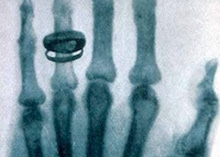X-ray by Wilhelm Roentgen