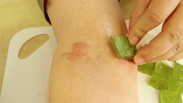 Aloe Vera bei Hautkrankheiten anwenden