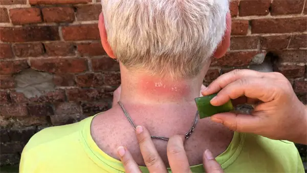 Aloe Vera gegen Sonnenbrand der Haut